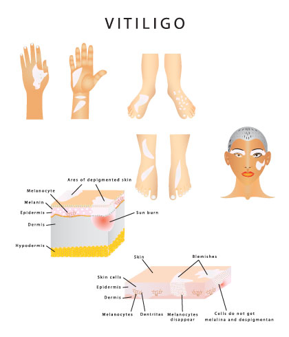 Is Vitiligo Hereditary?