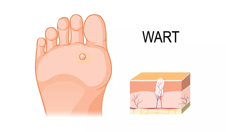 Reasons to treat warts with homeopathy