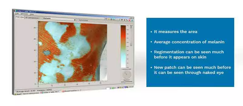 skin-analysis-of-vitiligo-through-3d-camera