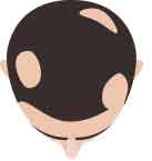 trichotillomania-thumb-1