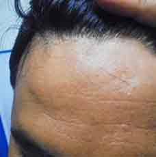 vitiligo-after-outcome