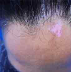 vitiligo-before-outcome