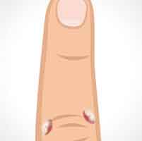 warts-img-2