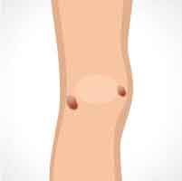 warts-img-3