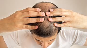 The Many Benefits of Homeopathy in Healing Hair Loss