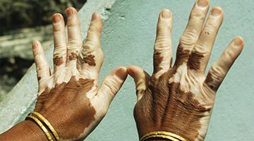What causes Vitiligo skin disease?
