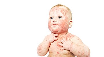 Eczema caused sleepless nights for my 1year old baby
