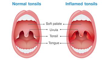What are the symptoms of tonsils?