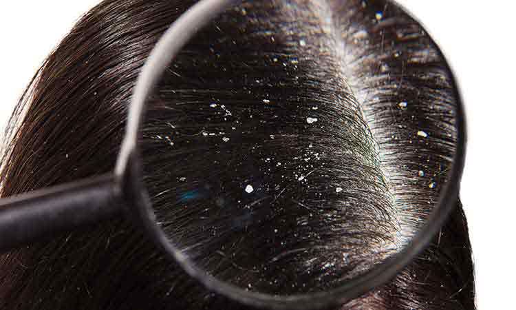 Homoeopathic Medicine Helped My Scalp Look Full of Hair… Homoeopathic Medicine Helped My Scalp Look Full of Hair…