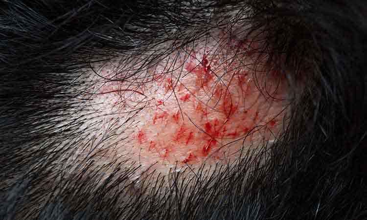Is Scarring Hair Loss a Permanent Hair Loss?