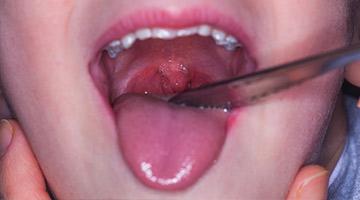 All about Tonsillitis