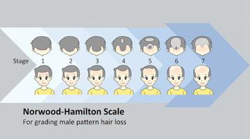 Hair Regrowth in Male Patterned Baldness