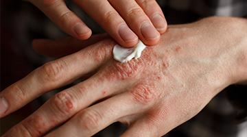 Homoeopathic Treatment for Psoriasis