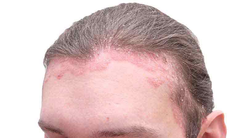 Dry Scalp What Causes a Flaky Itchy Scalp Heres How to Treat and  Prevent It  Glamour