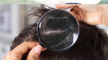 Advanced hair loss solutions for all your hair problems