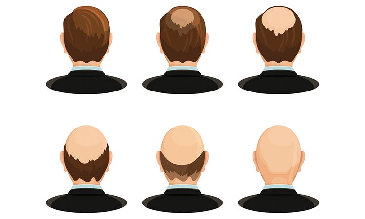 a Hereditary hair loss in a male patient  Download Scientific Diagram