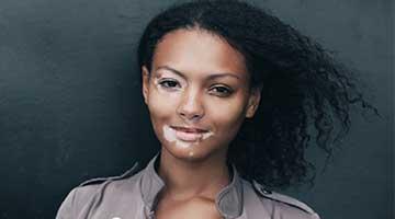 Can vitiligo be stopped or controlled from spreading?