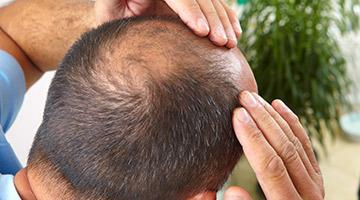 Factors responsible for causing Alopecia Areata