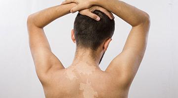 <p>Have you been suffering from white patches since long? Are you exhausted with all types of treatment? Try homeopathy and try to get rid of white patches… </p>  <p>Vitiligo is a pigmentation disorder as it causes the pigment making cells /color giving cells of the skin to deteriorate to produce milky white patches. Occurrence is equal in both sexes and all ages. In vitiligo there is a destruction of the skin pigment cells (melanocyte), which gives skin and hair it’s color through the formation of melanin 