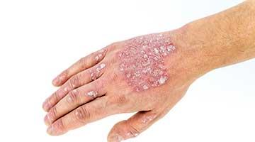 Homeopathy is a holistic way to treat Psoriasis