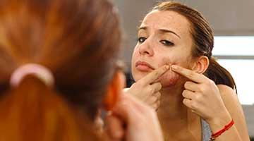 How to get rid of acne forever