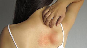 How to stop Psoriasis from Spreading?