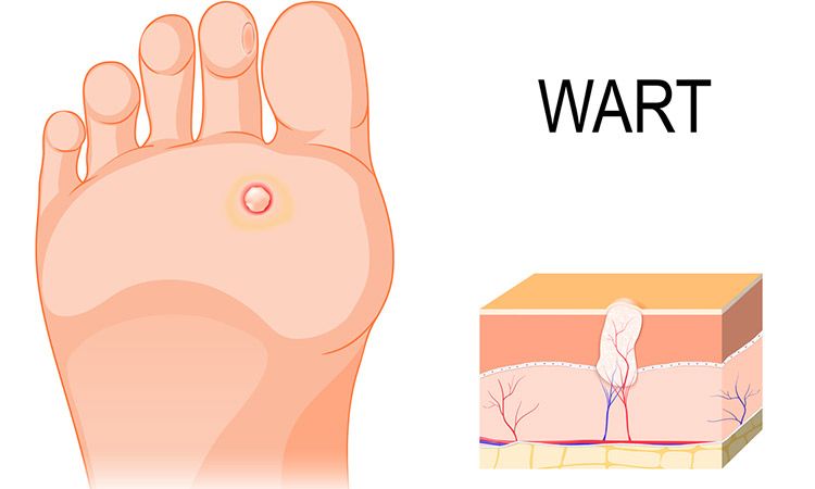 How to tell if it’s a wart?