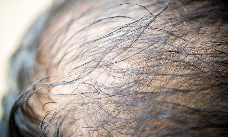 Success Story Alert New Female Hair Loss Treatment Entry