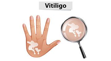 Vitiligo… when skin loses its pigmentation…