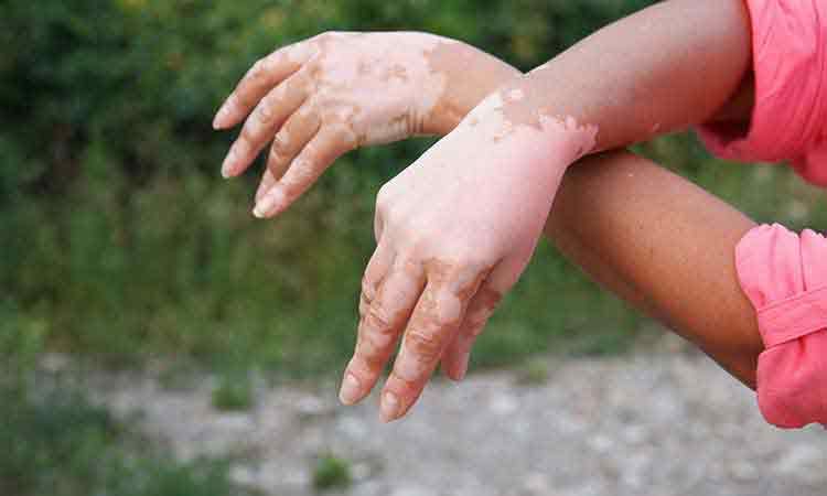 The 'White Lies': Debunking Vitiligo Myths & Facts The 'White Lies': Debunking Vitiligo Myths & Facts