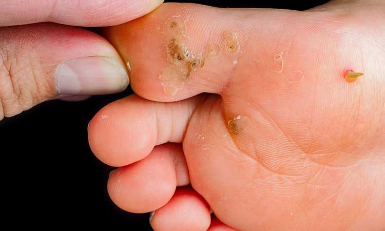 Warts: Treating them with homeopathy