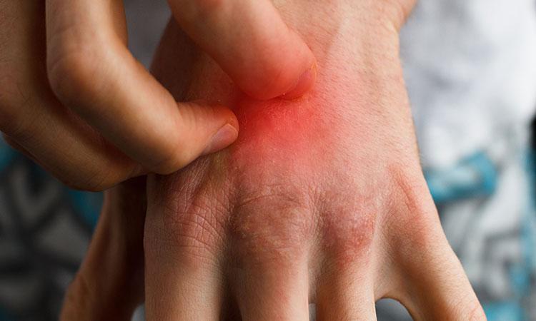 Know The Psoriasis Triggers And Stop The Itch