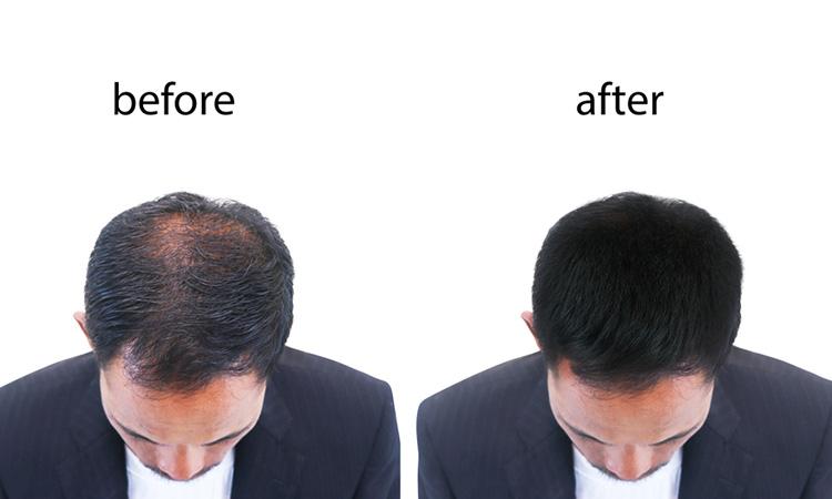 CAN GRO HAIR GROW THE HAIR? | Dr Batra's™