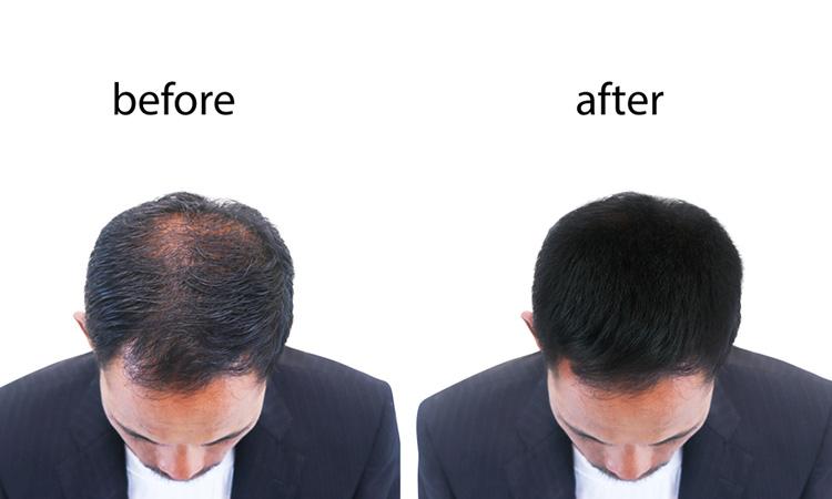 CAN GRO HAIR GROW THE HAIR? | Dr Batra's™ CAN GRO HAIR GROW THE HAIR? | Dr Batra's™