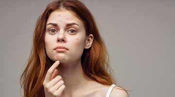 ACNE ON THE BODY? CAN HOMOEOPATHY HELP?