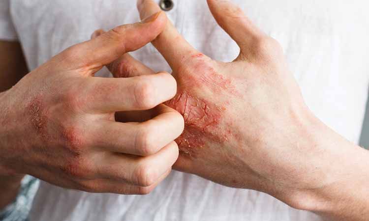 Can allergies worsen eczema?