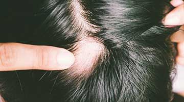 Can alopecia areata be treated?