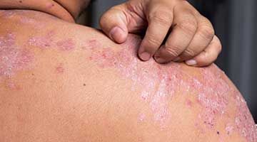 SCOPE OF HOMEOPATHY IN TREATING PSORIASIS!