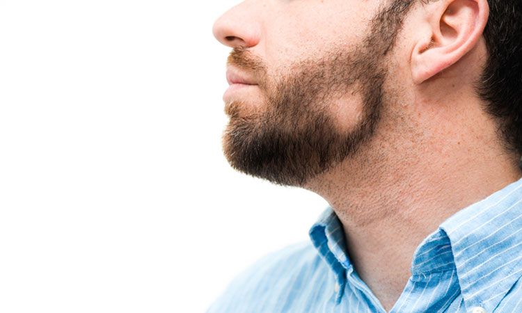 Bald spots in your beard? You could be suffering from alopecia | Dr Batra's™