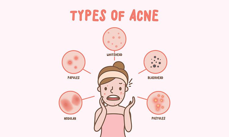 acne scars homeopathic medicine - Online Discount Shop for Electronics, Apparel, Toys, Books, Games, Computers, Shoes, Jewelry, Watches, Baby Products, Sports & Outdoors, Office Products, Bed & Bath, Furniture, Tools, Hardware, Automotive
