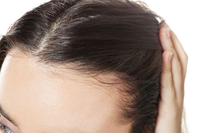 Female Hair Loss Causes  What Causes Hair Loss in Women