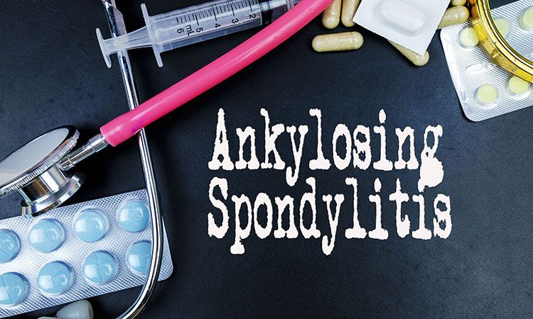 Ankylosing Spondylitis: The simplicity behind this complex term.