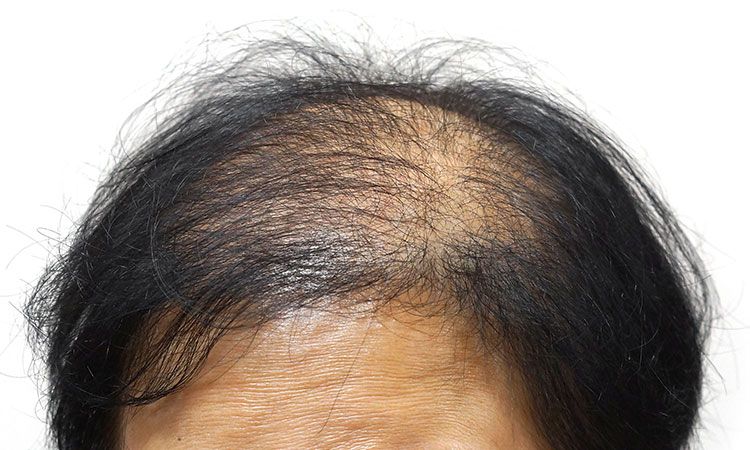 Is your hair loss just due to stress or there is some underlying disease  causing it? | Dr Batra's™