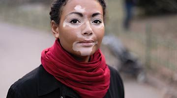 Vitiligo: Homeopathic help for a disfiguring skin disorder 