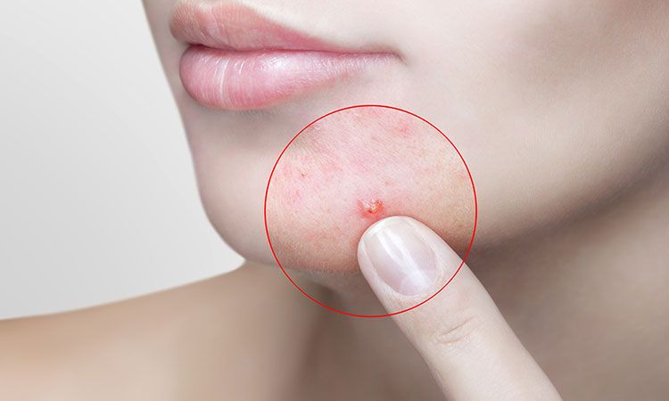 Want to get rid of that ever-present acne? Here’s why you should consider Homeopathy.