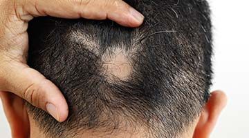 Can alopecia be cured with homeopathy? 
