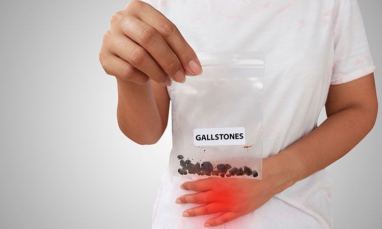 Does Homeopathy have a treatment for Cholecystitis Gallstones?