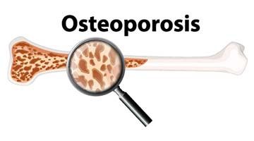 Osteoporosis is not always inherited. Know the causes and the symptoms.
