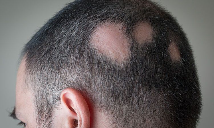 Alopecia Areata: Causes & Treatment Options