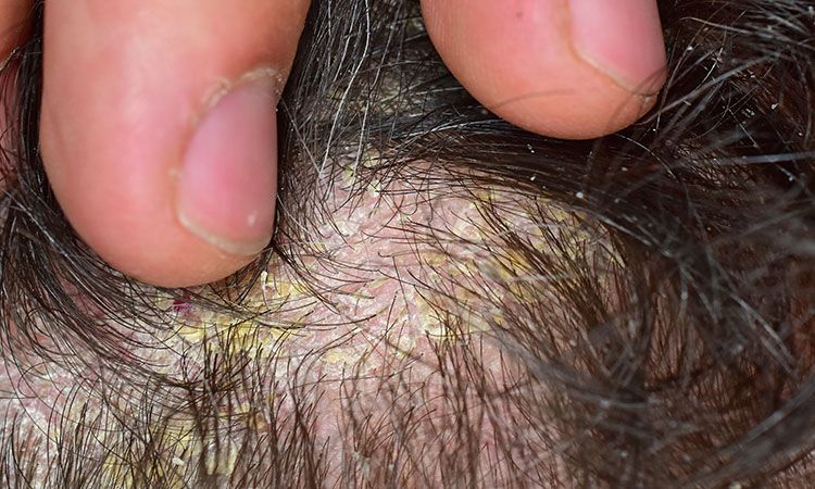 Scalp Psoriasis A Complete Overview  DermNet